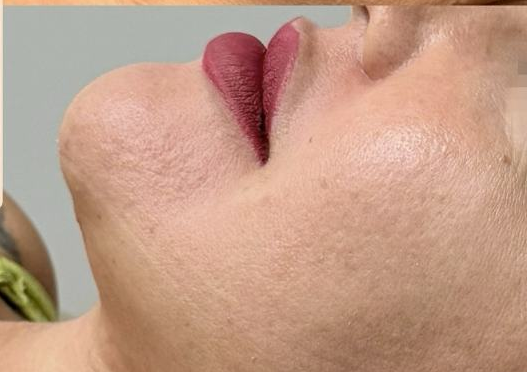 Resultado — Dra. Aline Esmeraldino | E.Clinic Orofacial
