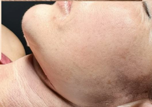 Resultado — Dra. Aline Esmeraldino | E.Clinic Orofacial