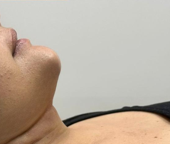 Resultado — Dra. Aline Esmeraldino | E.Clinic Orofacial